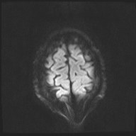 File:Cerebral toxoplasmosis (Radiopaedia 43956-47461 Axial DWI 19).jpg