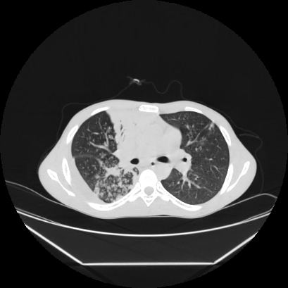 File:Cerebral tuberculoma (Radiopaedia 80829-94318 Axial lung window 73).jpg