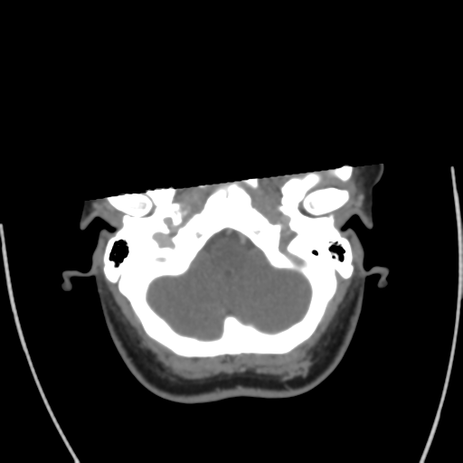 Cerebral venous infarct related to dural venous sinus thromboses (Radiopaedia 35292-36804 Axial C+ delayed 9).png
