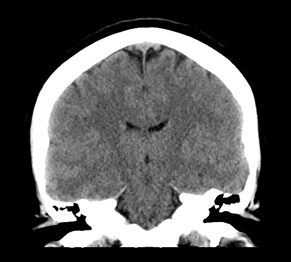 File:Cerebral venous infarct related to dural venous sinus thromboses (Radiopaedia 35292-36804 Coronal non-contrast 20).png