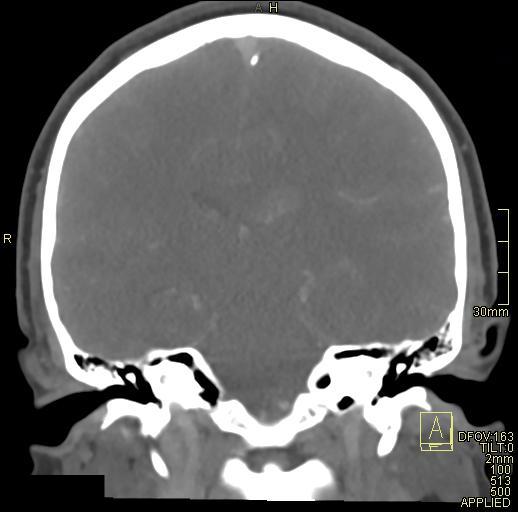 Cerebral venous sinus thrombosis (Radiopaedia 91329-108965 Coronal venogram 51).jpg
