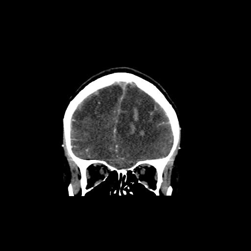 File:Cerebral venous throbmosis - hemorrhagic venous infarction (Radiopaedia 87318-103613 Coronal CT venogram 3).jpg