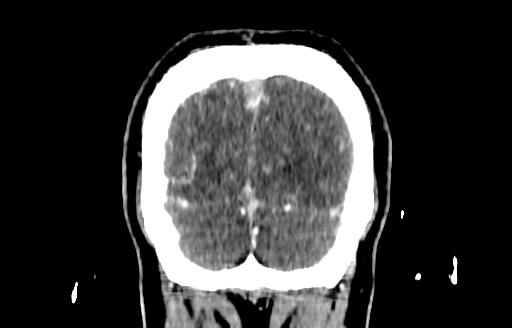 Cerebral venous thrombosis (CVT) (Radiopaedia 77524-89685 C 58).jpg
