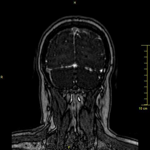 Cerebral venous thrombosis (Radiopaedia 23288-23351 MRV 151).JPG