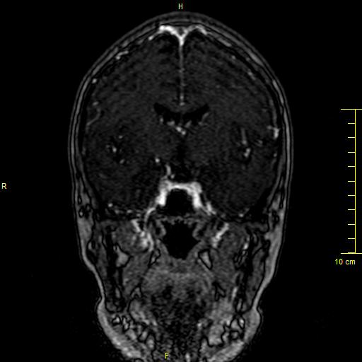 Cerebral venous thrombosis (Radiopaedia 23288-23351 MRV 63).JPG