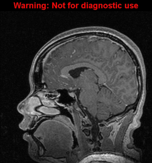 Cerebral venous thrombosis (Radiopaedia 37224-39208 Sagittal T1 C+ 72).jpg