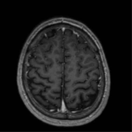 Cerebral venous thrombosis (Radiopaedia 38392-40469 Axial T1 C+ 64).png