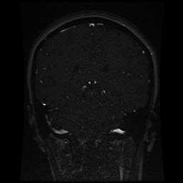 Cerebral venous thrombosis - ulcerative colitis (Radiopaedia 66049-75219 Coronal MRV 47).jpg