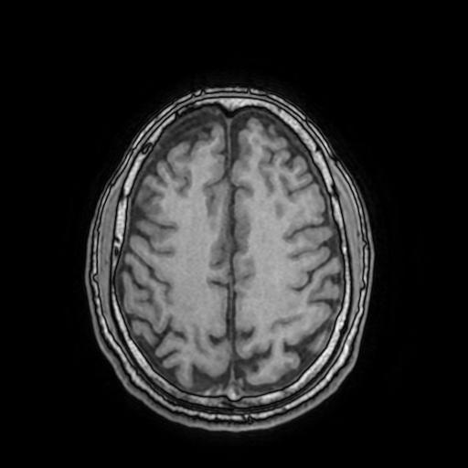 File:Cerebral venous thrombosis with secondary intracranial hypertension (Radiopaedia 89842-106957 Axial T1 127).jpg
