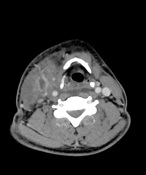 Cervical abscess (Radiopaedia 43725-47184 A 40).png