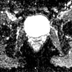 File:Cervical adenocarcinoma (Radiopaedia 65011-73985 Axial ADC 10).jpg