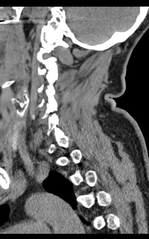 Cervical canal stenosis due to ossification of the posterior longitudinal ligament (Radiopaedia 47260-51823 D 24).png