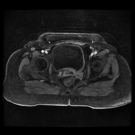 File:Cervical carcinoma (Radiopaedia 70924-81132 Axial T1 C+ fat sat 131).jpg