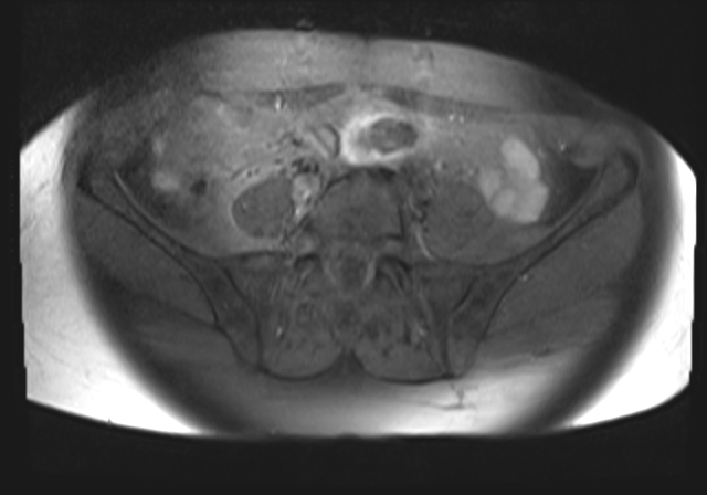 File:Cervical carcinoma (Radiopaedia 88312-104943 Axial T1 fat sat 3).jpg