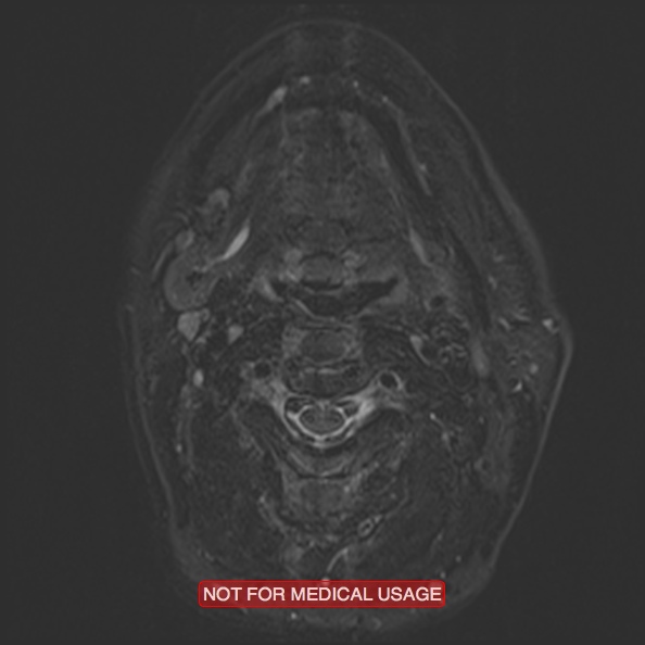 File:Cervical nerve schwannoma (Radiopaedia 27964-28221 C 26).jpg