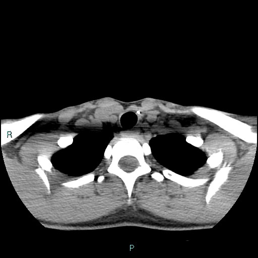 Cervical thymic cyst (Radiopaedia 88632-105335 Axial non-contrast 31).jpg
