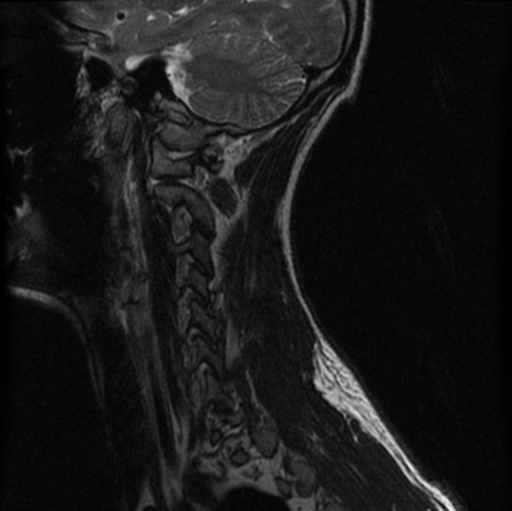 File:Cervical vertebrae metastasis (Radiopaedia 78814-91667 Sagittal T2 1).png
