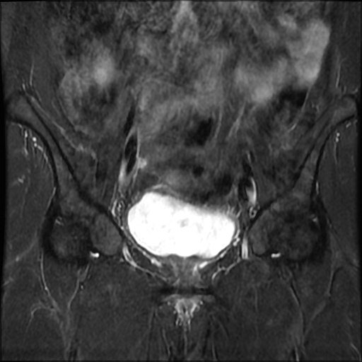 File:Cesarian section scar endometriosis (Radiopaedia 66520-75799 Coronal STIR 13).jpg
