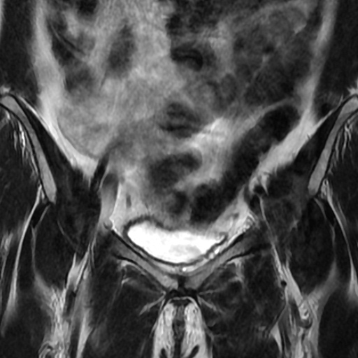 File:Cesarian section scar endometriosis (Radiopaedia 66520-75799 Coronal T2 11).jpg