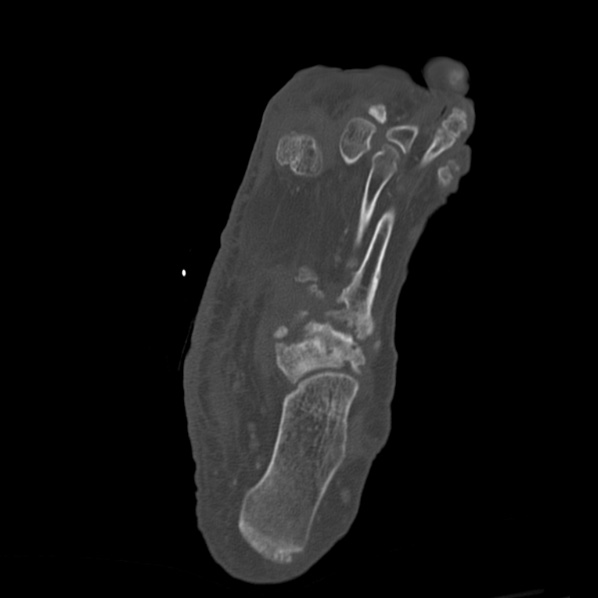 Charcot joint (Radiopaedia 36629-38194 Axial bone window 53).jpg