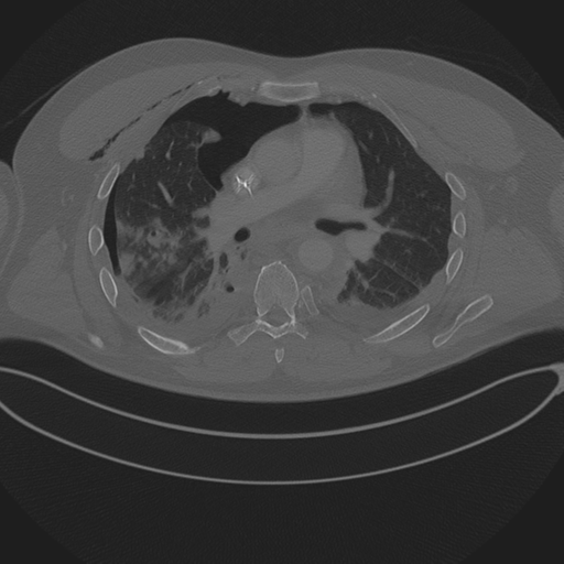 Chest multitrauma - aortic injury (Radiopaedia 34708-36147 Axial bone window 139).png