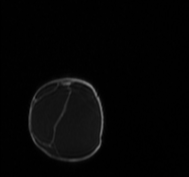 Chiari III malformation with occipital encephalocele (Radiopaedia 79446-92559 Coronal T1 C+ mpr 68).jpg