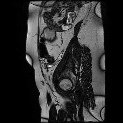 Chiari II malformation - fetal MRI (Radiopaedia 68099-77581 Sagittal Fiesta 49).jpg