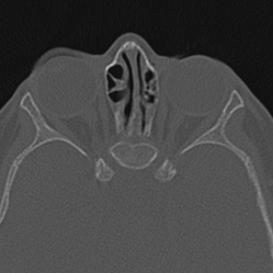 Choanal atresia (Radiopaedia 88525-105975 Axial bone window 86).jpg