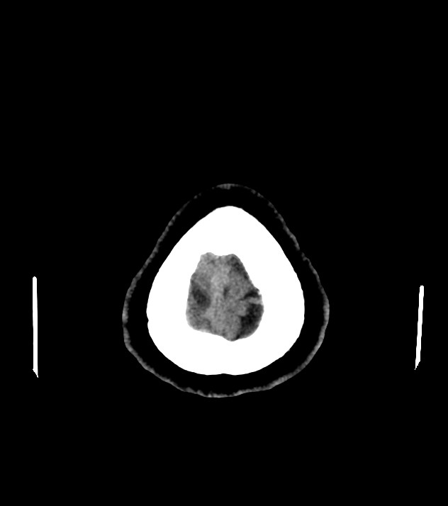 Cholangiocarcinoma with cerebral metastases (Radiopaedia 83519-98628 Axial non-contrast 61).jpg