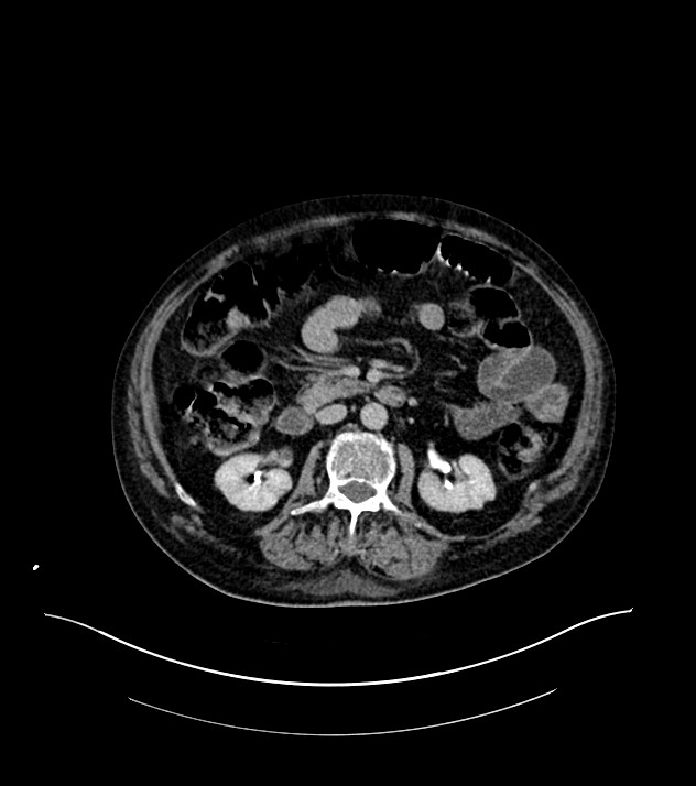 Cholangiocarcinoma with cerebral metastases (Radiopaedia 83519-98629 Axial C+ delayed 51).jpg