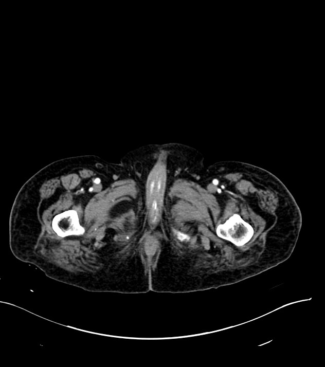 Cholangiocarcinoma with cerebral metastases (Radiopaedia 83519-98629 B 138).jpg