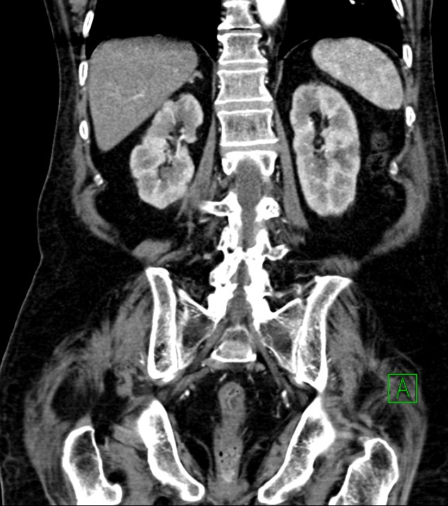 Cholangiocarcinoma with cerebral metastases (Radiopaedia 83519-98629 E 63).jpg