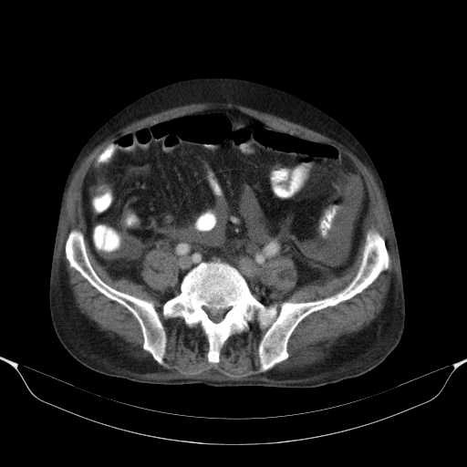 File:Cholangitis and abscess formation in a patient with cholangiocarcinoma (Radiopaedia 21194-21100 A 36).jpg