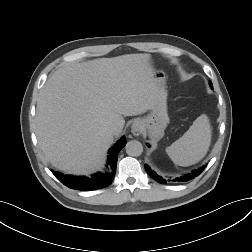 Cholecystitis with focal perforation and hepatic abscess (Radiopaedia 37189-38945 Axial non-contrast 15).png
