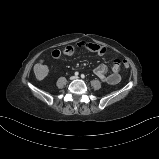 Cholecystoduodenal fistula due to calculous cholecystitis with gallstone migration (Radiopaedia 86875-103077 D 51).jpg