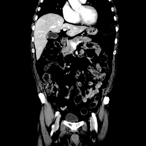 Choledocholiathiasis with normal caliber common bile duct (Radiopaedia 75368-86632 Coronal liver window 51).jpg