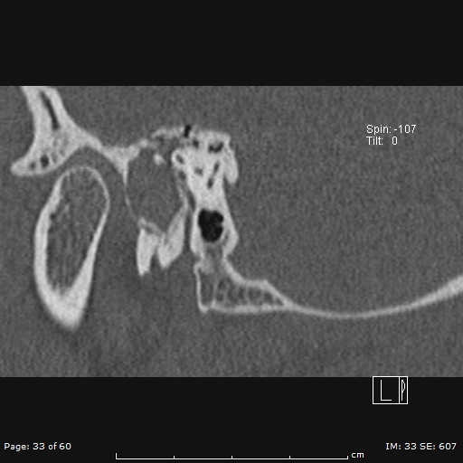 Cholesteatoma - external auditory canal (Radiopaedia 88452-105096 Sagittal bone window 33).jpg