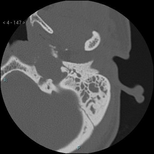 Cholesterol granuloma of the petrous apex (Radiopaedia 64358-73141 Axial bone window 71).jpg