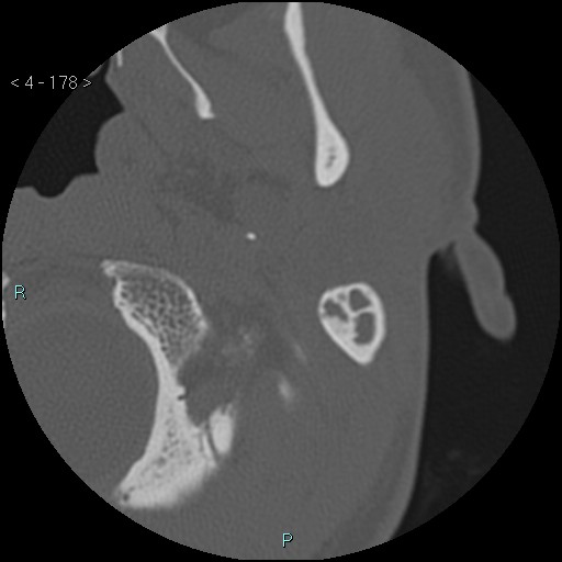 File:Cholesterol granuloma of the petrous apex (Radiopaedia 64358-73141 Axial bone window 86).jpg