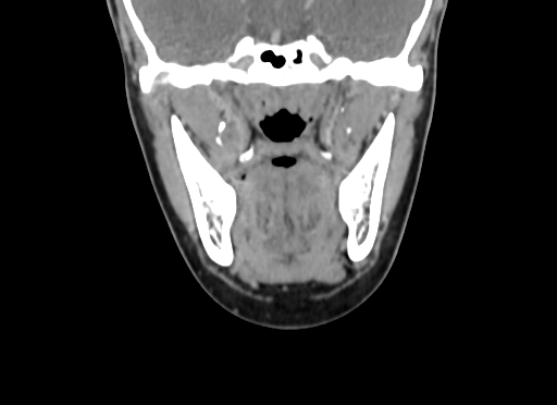 File:Chondroblastic osteosarcoma (Radiopaedia 67363-76741 D 55).jpg