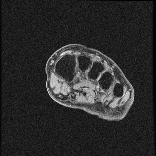 File:Chondroblastoma - midfoot (Radiopaedia 64831-73765 F 20).jpg