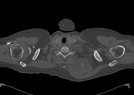 Chondrosarcoma - chest wall (Radiopaedia 65192-74199 Axial bone window 4).jpg