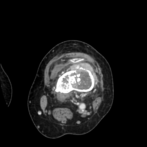 Chondrosarcoma - femur (Radiopaedia 64187-72954 Axial with contrast 34).jpg