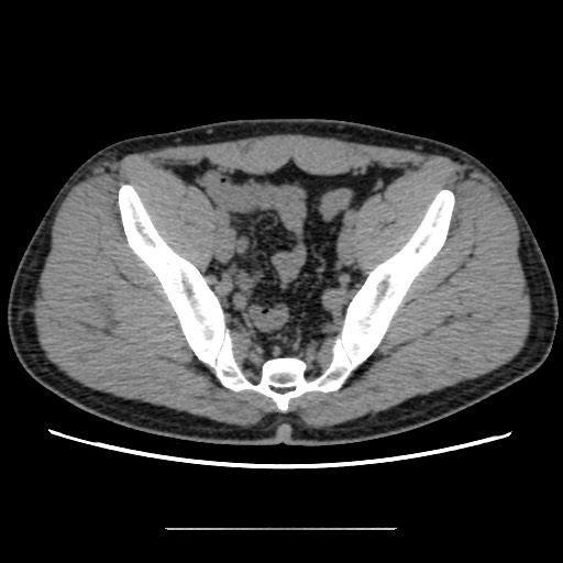 File:Chondrosarcoma of iliac wing (Radiopaedia 63861-72599 Axial non-contrast 74).jpg