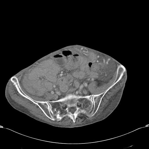 File:Chondrosarcoma of the spine (Radiopaedia 49871-55143 A 46).jpg