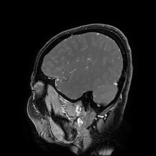 Chordoid glioma of third ventricle (Radiopaedia 91612-109340 F 159).jpg