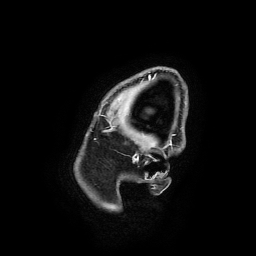 Chordoid glioma of third ventricle (Radiopaedia 91612-109340 F 19).jpg