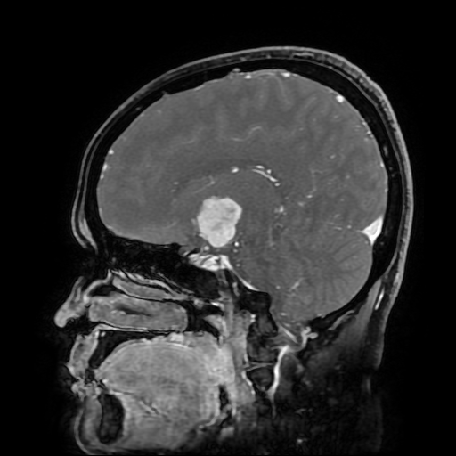 File:Chordoid glioma of third ventricle (Radiopaedia 91612-109340 F 94).jpg