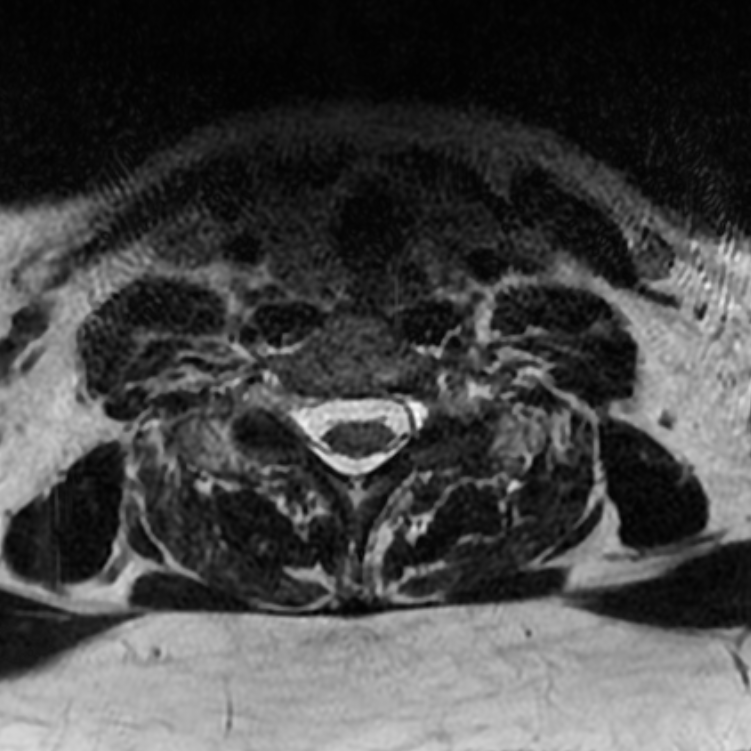 Chordoma - cervical spine (Radiopaedia 70084-80111 Axial T2 74).png