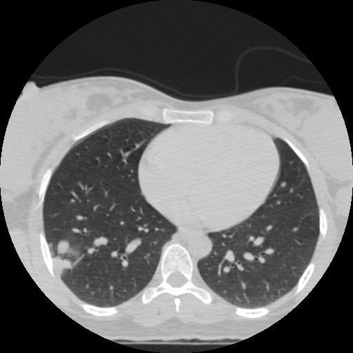 File:Choriocarcinoma of ovary with cerebral and pulmonary metastases (Radiopaedia 25983-26119 Axial lung window 4).jpg